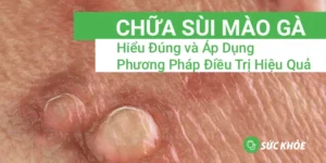 chữa sùi mào gà