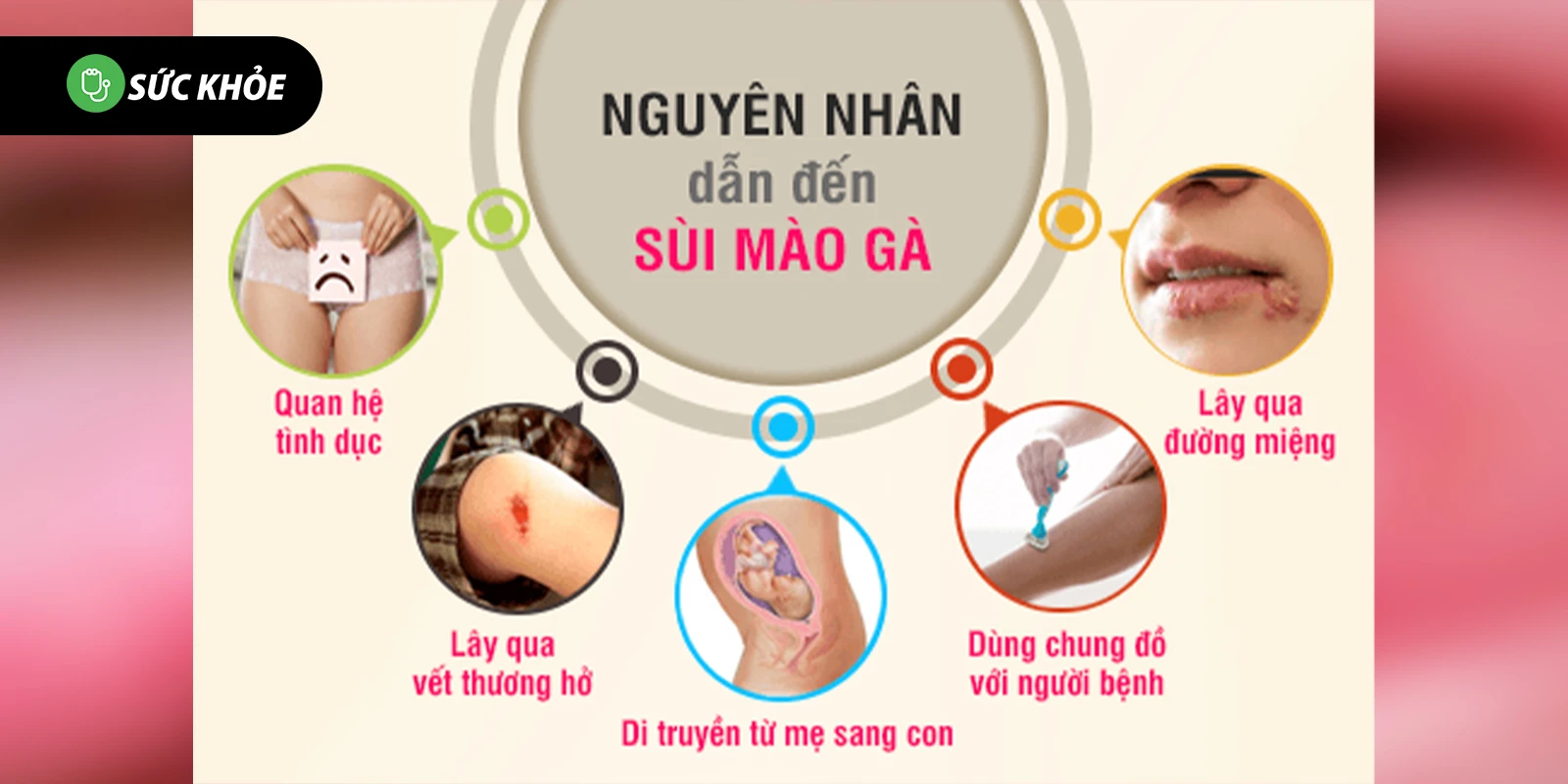 sùi mào gà lây qua đường gì