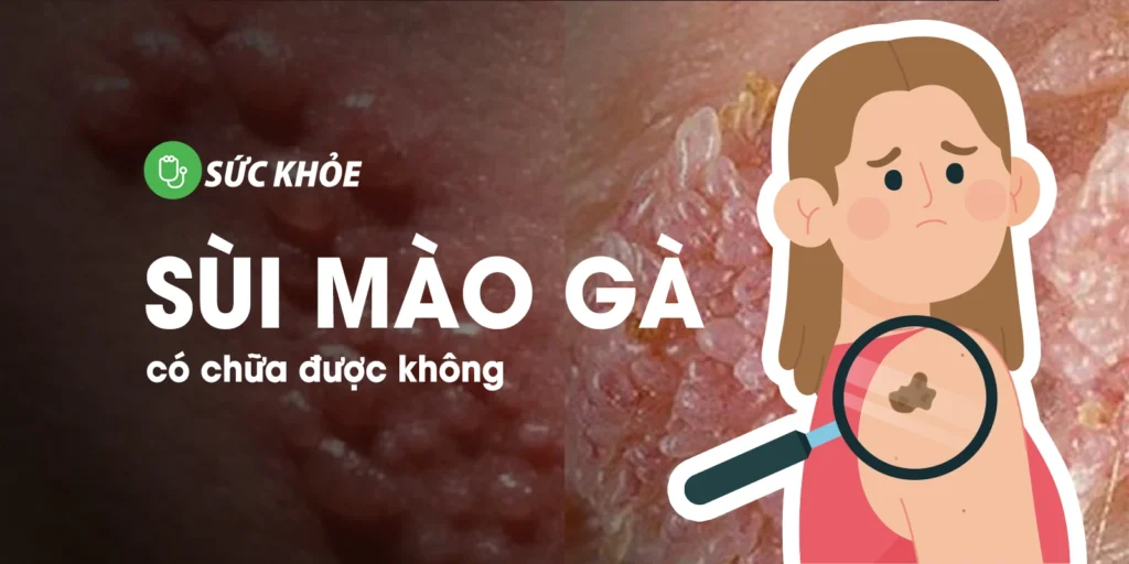 sùi mào gà có chữa được không