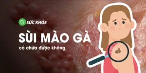 sùi mào gà có chữa được không