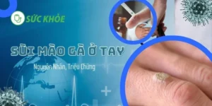 sùi mào gà ở tay